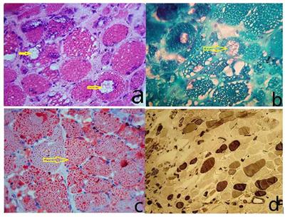 Case Report: PNPLA2 Gene Complex Heterozygous Mutation Leading to Neutral Lipid Storage Disease With Myopathy